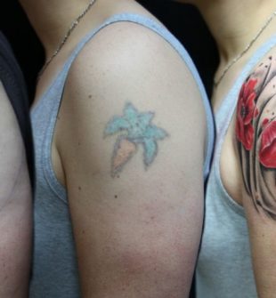 Fjerning av tatovering med moderne laser